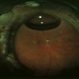 C3F8 gas bubble after retinal detachment surgery